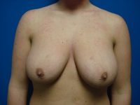 Breast Lift