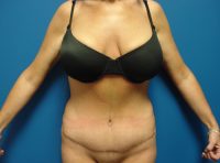 Abdominoplasty