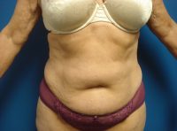 Abdominoplasty