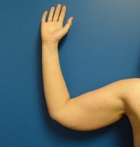 Arm Lift
