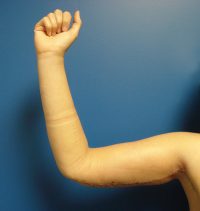 Arm Lift