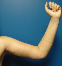 Arm Lift