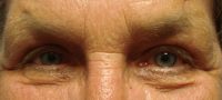 Blepharoplasty