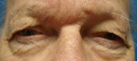 Blepharoplasty