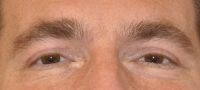 Blepharoplasty