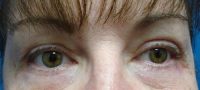 Blepharoplasty