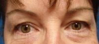 Blepharoplasty