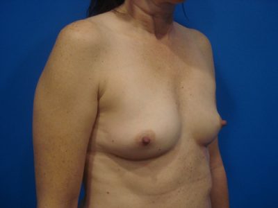 Breast Augmentation Before & After Photos