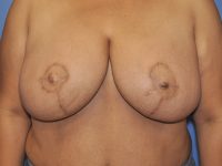 Nipple Tattoo & Nipple Reconstruction Before & After Gallery