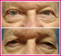 Eyelid Surgery Before and After Eyelid Surgery Before and After