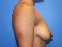 Breast Augmentation Before & After Photos