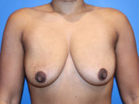 Breast Augmentation Before & After Photos