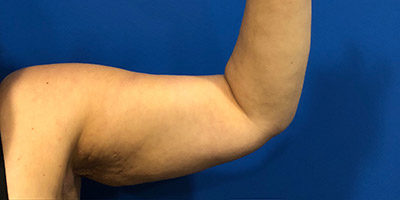 Arm Lift