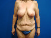 Mommy Makeover Before & After Photos