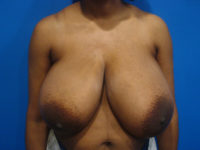 Breast Reduction Before & After Photos