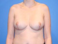 Breast Reduction Before & After Photos