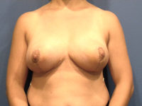 Breast Reduction Before & After Photos