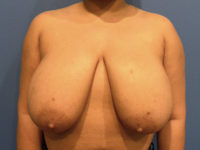 Breast Reduction Before & After Photos