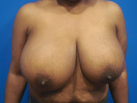 Breast Reduction Before & After Photos