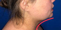 Facetite Before and After Photos Facetite Before and After Photos