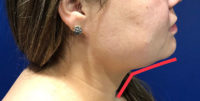 Facetite Before and After Photos Facetite Before and After Photos