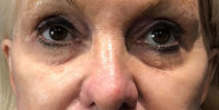 Tear Trough Filler