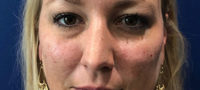Tear Trough Filler