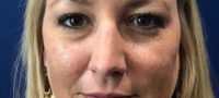 Tear Trough Filler