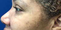 Tear Trough Filler