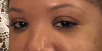 Tear Trough Filler
