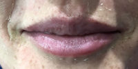 Lip Filler