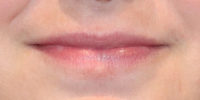 Lip Filler