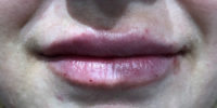 Lip Filler