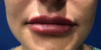 Lip Filler