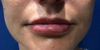 Lip Filler