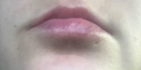 Lip Filler