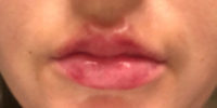Lip Filler