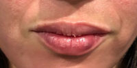 Lip Filler