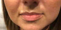 Lip Filler