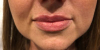 Lip Filler