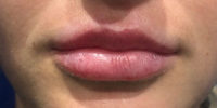 Lip Filler
