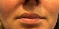 Lip Filler