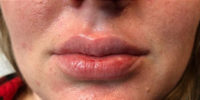 Lip Filler