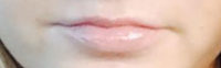 Lip Filler