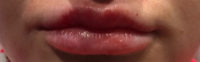 Lip Filler