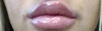Lip Filler