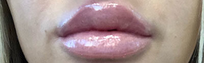 Lip Filler