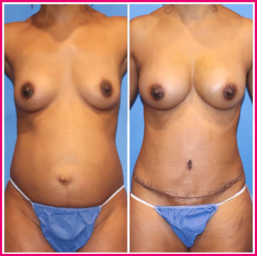 Mommy Makeover Before and After Austin Texas