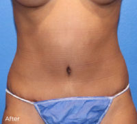 Abdominoplasty