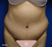Abdominoplasty